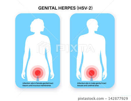 Groin infection site comparison Groin infection site comparison 142877929