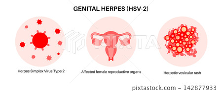 Vesicular rash infographic layout Vesicular rash infographic layout 142877933