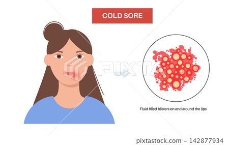 Herpes simplex virus HSV1 Herpes simplex virus HSV1 142877934