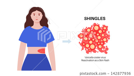 Female flank vesicles transition Female flank vesicles transition 142877936