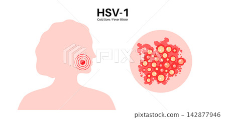 Herpes simplex virus HSV1 Herpes simplex virus HSV1 142877946