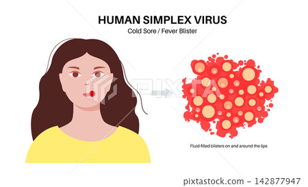 Herpes simplex virus HSV1 Herpes simplex virus HSV1 142877947