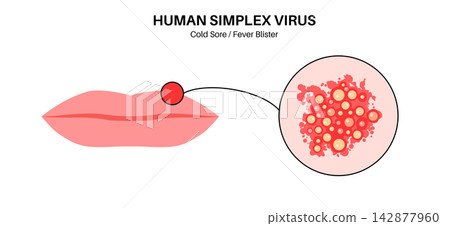 Herpes simplex virus HSV1 Herpes simplex virus HSV1 142877960