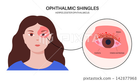 Female rash zoom infographic Female rash zoom infographic 142877968