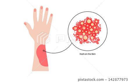 Arm wrist blister zoom Arm wrist blister zoom 142877973