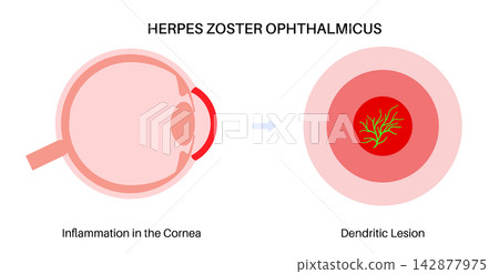 Magnified lesion zone scheme Magnified lesion zone scheme 142877975
