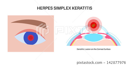 Cornea layers dendritic lesion Cornea layers dendritic lesion 142877976