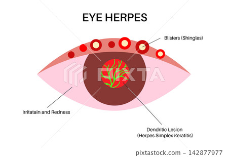 Eye anatomy infection symptoms Eye anatomy infection symptoms 142877977