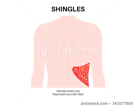 Flank skin rash poster Flank skin rash poster 142877989