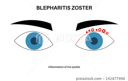 Eyelids inflammation comparison outline Eyelids inflammation comparison outline 142877998