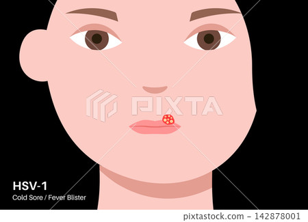 Herpes simplex virus HSV1 Herpes simplex virus HSV1 142878001