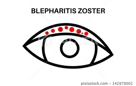 Stroke outline blepharitis icon Stroke outline blepharitis icon 142878002