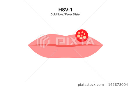 Herpes simplex virus HSV1 Herpes simplex virus HSV1 142878004