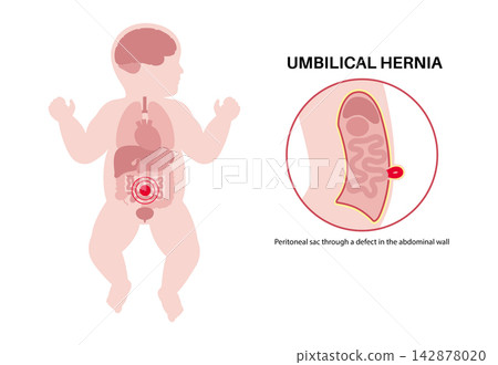 Abdominal Hernia poster 142878020