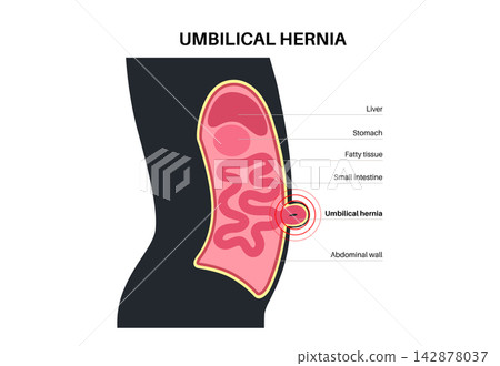 Abdominal Hernia poster Abdominal Hernia poster 142878037
