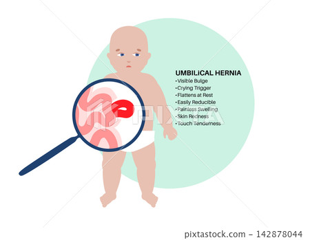 Abdominal Hernia poster Abdominal Hernia poster 142878044