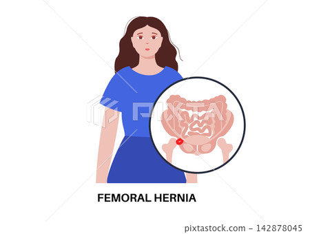 Abdominal Hernia poster Abdominal Hernia poster 142878045