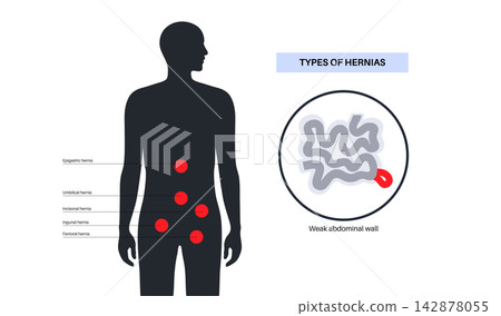 Abdominal Hernia poster Abdominal Hernia poster 142878055