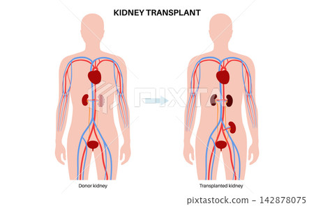 Kidney transplant surgery Kidney transplant surgery 142878075