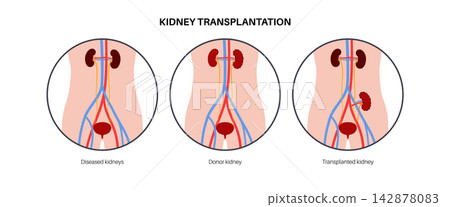 Kidney transplant surgery Kidney transplant surgery 142878083