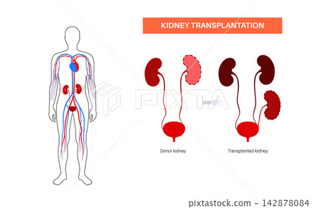 Kidney transplant surgery Kidney transplant surgery 142878084