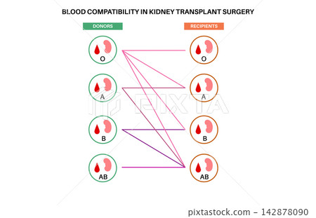 Kidney transplant surgery Kidney transplant surgery 142878090