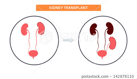 Kidney transplant surgery Kidney transplant surgery 142878110