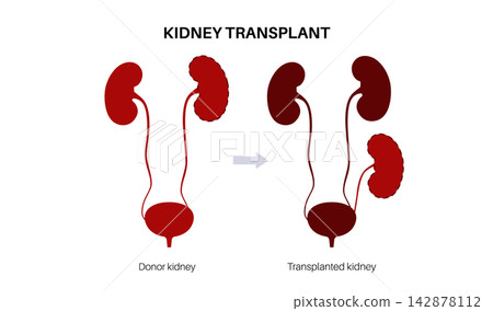 Kidney transplant surgery Kidney transplant surgery 142878112