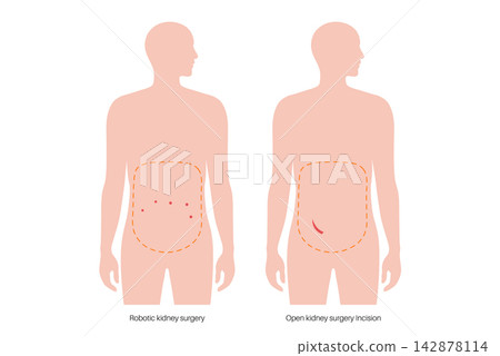 Kidney transplant surgery 142878114