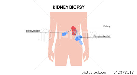 Kidney transplant surgery Kidney transplant surgery 142878118