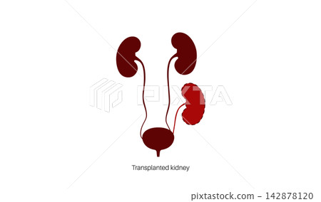 Kidney transplant surgery Kidney transplant surgery 142878120