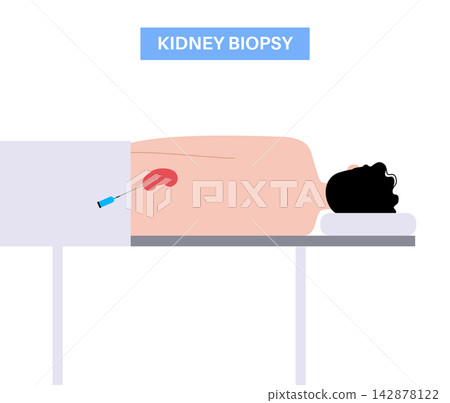 Kidney transplant surgery Kidney transplant surgery 142878122