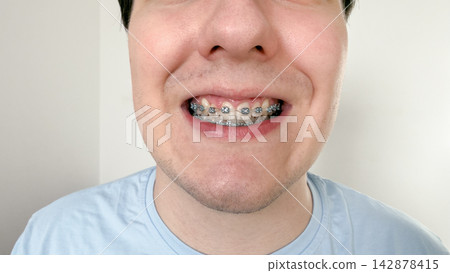 Close up of a man with dental braces smiling, concept of oral hygiene and orthodontic treatment Close up of a man with dental braces smiling, concept of oral hygiene and orthodontic treatment 142878415