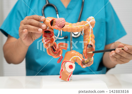 Colorectal cancer, doctor holding intestine colon human model. Colorectal cancer, doctor holding intestine colon human model. 142883816