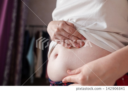 Woman touching stretch marks on belly skin. Close up of female hands holding stomach with striae after pregnancy or weight loss. Woman touching stretch marks on belly skin. Close up of female hands holding stomach with striae after pregnancy or weight loss. 142906841