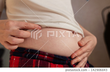 Woman touching stretch marks on belly skin. Close up of female hands holding stomach with striae after pregnancy or weight loss. Woman touching stretch marks on belly skin. Close up of female hands holding stomach with striae after pregnancy or weight loss. 142906843