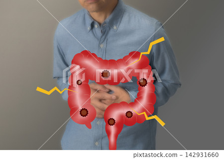 Diseases of the large intestine: Image of colon cancer Diseases of the large intestine: Image of colon cancer 142931660