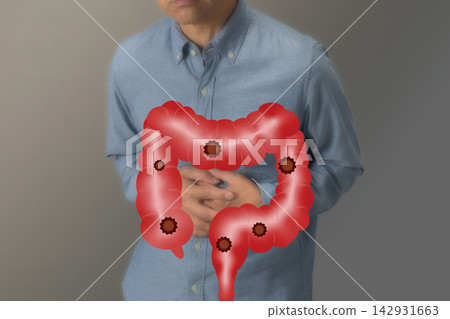 Diseases of the large intestine: Image of colon cancer 142931663