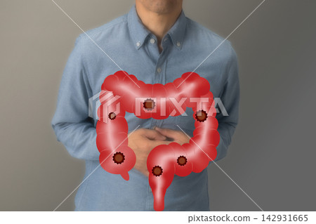 Diseases of the large intestine: Image of colon cancer Diseases of the large intestine: Image of colon cancer 142931665