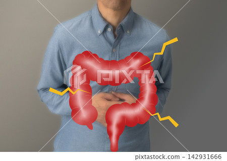 Diseases of the large intestine: Image of colon cancer Diseases of the large intestine: Image of colon cancer 142931666