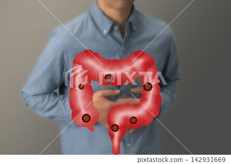 大腸疾病:結腸癌圖片 大腸疾病:結腸癌圖片 142931669
