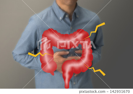 大腸疾病:結腸癌圖片 大腸疾病:結腸癌圖片 142931670