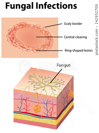 Medical Illustration of Fungal Skin Infection and Ringworm Lesion Anatomy Medical Illustration of Fungal Skin Infection and Ringworm Lesion Anatomy 142932709