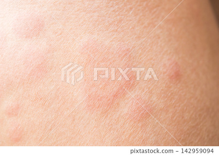 Skin allergy rash dermatitis texture close up background 142959094