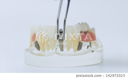 Dentist using metal tweezers to place a titanium abutment into a transparent educational dental implant model of the jaw. Dentist using metal tweezers to place a titanium abutment into a transparent educational dental implant model of the jaw. 142972023