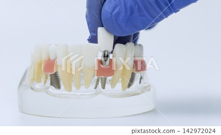 Oral surgery education concept demonstrating tooth restoration process as a doctor attaches a prosthetic crown to a metal dental implant model. Oral surgery education concept demonstrating tooth restoration process as a doctor attaches a prosthetic crown to a metal dental implant model. 142972024