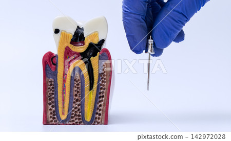 Root canal treatment education concept with dentist hand holding endodontic instrument near anatomical cross section model of decayed tooth. Root canal treatment education concept with dentist hand holding endodontic instrument near anatomical cross section model of decayed tooth. 142972028