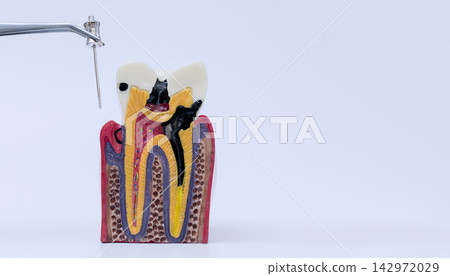 Endodontic treatment concept showing metal tweezers holding a dental file near a cross section anatomical model of a decayed tooth with copy space. 142972029