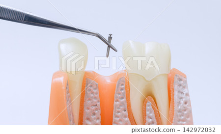 Orthodontic mini implant screw placement demonstration with dental tweezers above anatomical teeth and gum model Orthodontic mini implant screw placement demonstration with dental tweezers above anatomical teeth and gum model 142972032