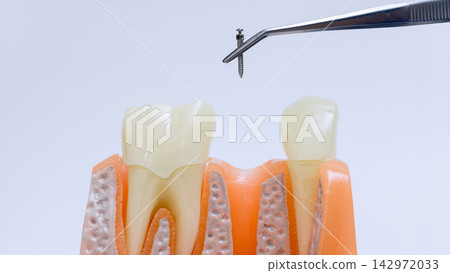Orthodontic miniscrew placement concept with precision dental tweezers above anatomical teeth and gingiva model Orthodontic miniscrew placement concept with precision dental tweezers above anatomical teeth and gingiva model 142972033